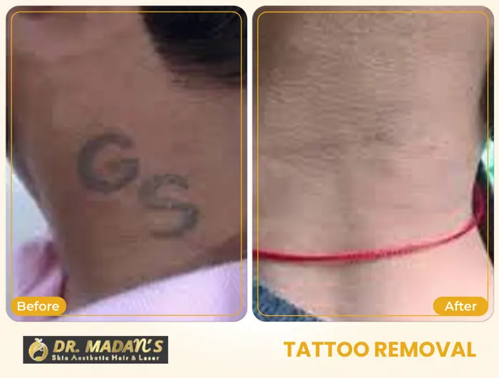 Tattoo removal before and after result 13 at Dr Madan Aesthetics